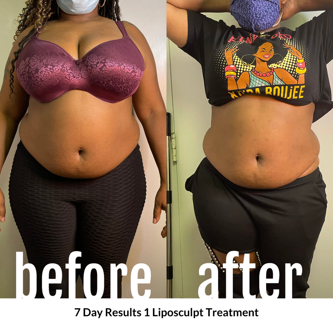 LipoSculpt package of 3 sessions